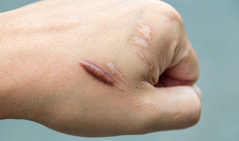 Kem trị sẹo Contractubex Đức